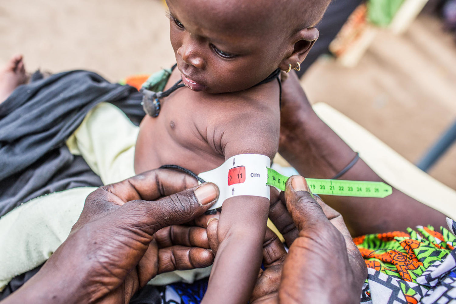 Malnutrition World Health Organization WHO