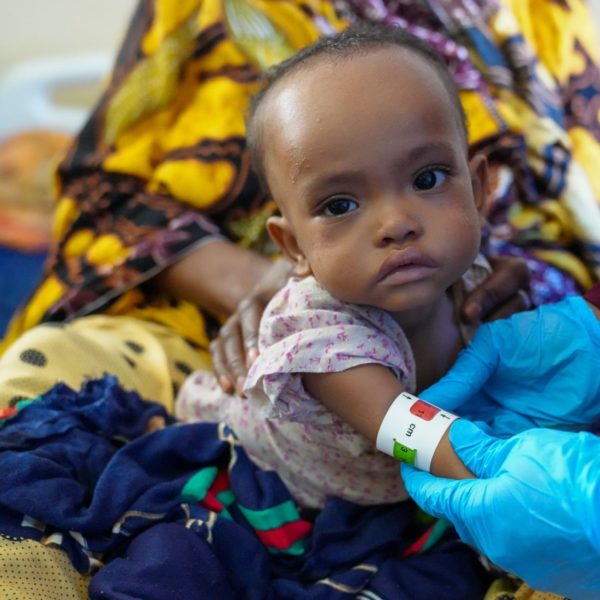 Child in Somalia suffering from severe malnutrition