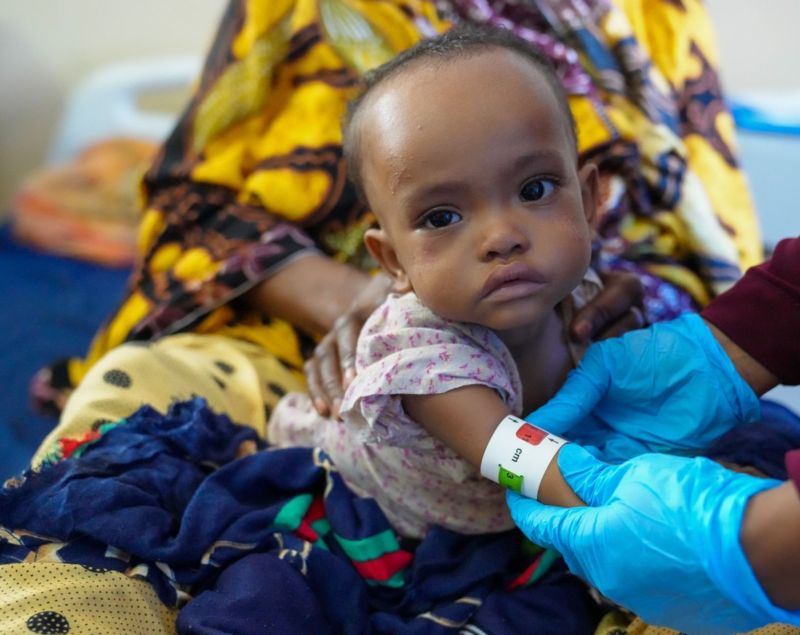 Child in Somalia suffering from severe malnutrition